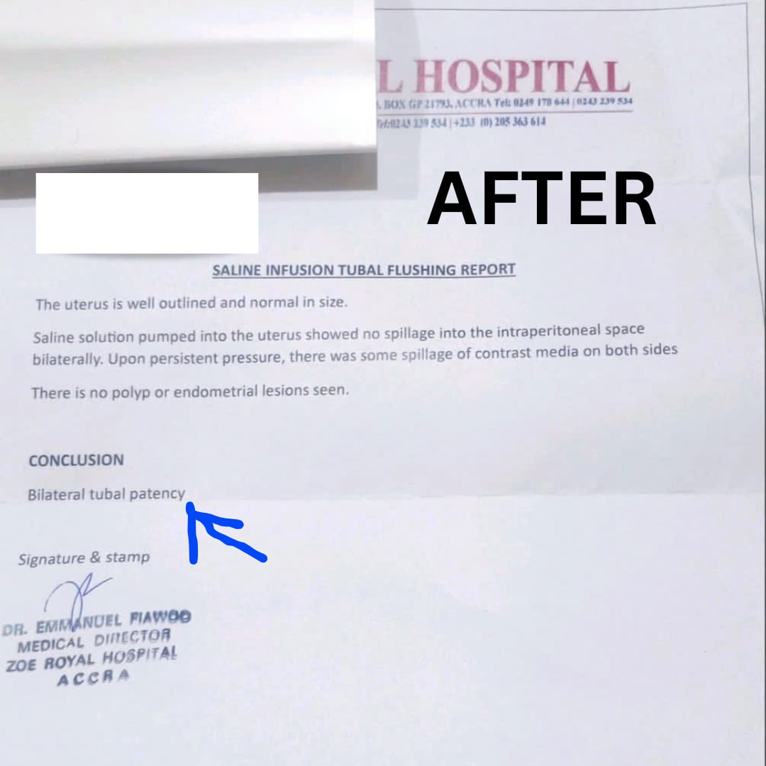 After — Bilateral Tubal Patency report