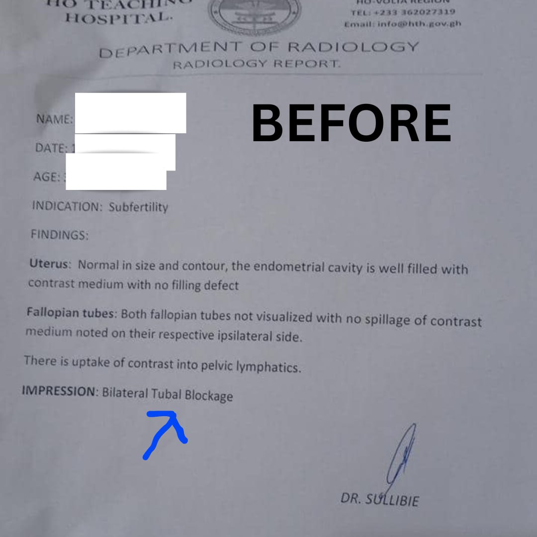 Before — Bilateral Tubal Blockage radiology report