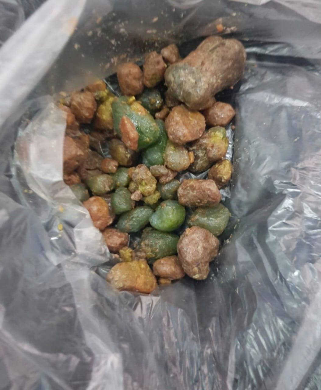 Gallbladder stones expelled — mixed green and brown stones in bag