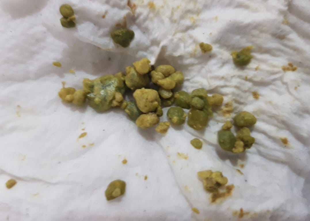 Green gallbladder stones on tissue