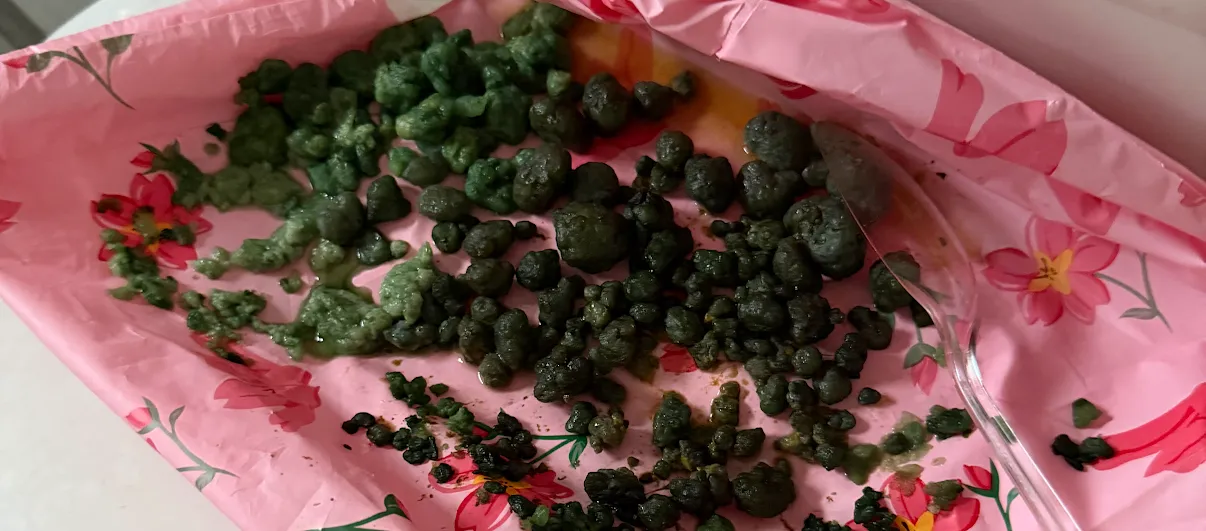 Large collection of green gallbladder stones on pink paper — Felchris patient