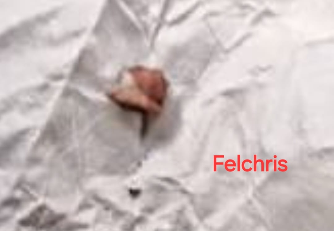 Kidney stone expelled by Felchris patient
