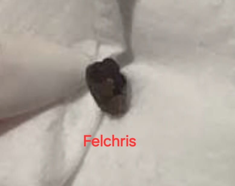 Multiple kidney stones expelled — Felchris patient
