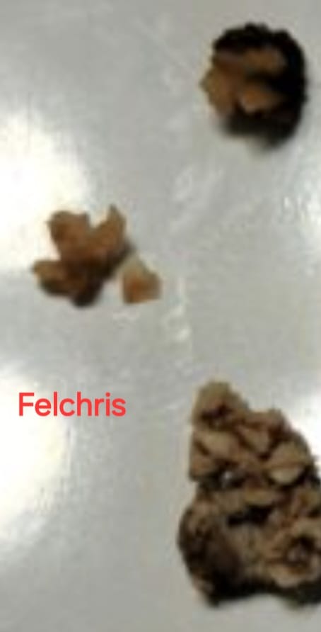 Collection of kidney stones passed — Felchris patient