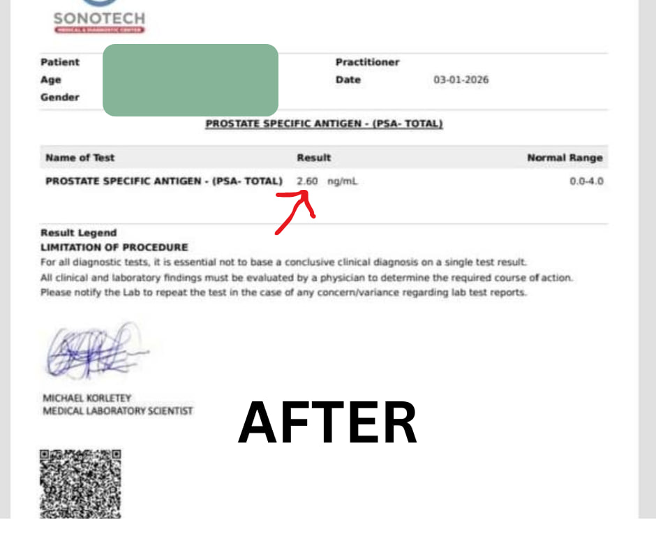 After — PSA 2.60 ng/mL