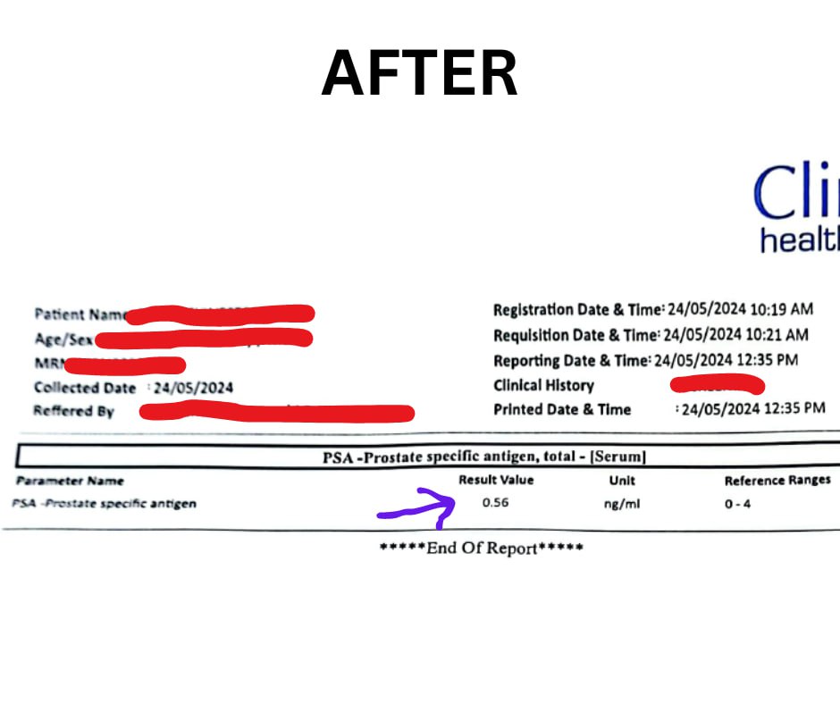 After — PSA 0.56 ng/mL