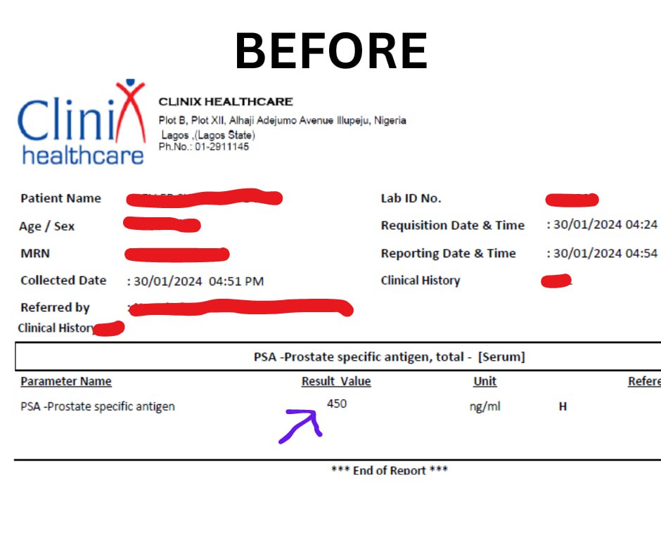 Before — PSA 450 ng/mL